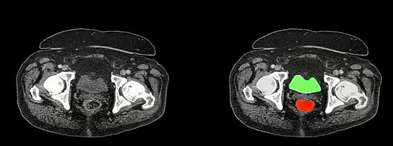 AI-Powered AbdomenAtlas: A Game Changer in Early Cancer Detection and Medical Imaging