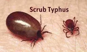 Tamil Nadu Health Department on High Alert as Scrub Typhus Cases Rise