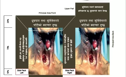 Nepal leads the world with largest pictorial health warnings on all tobacco products