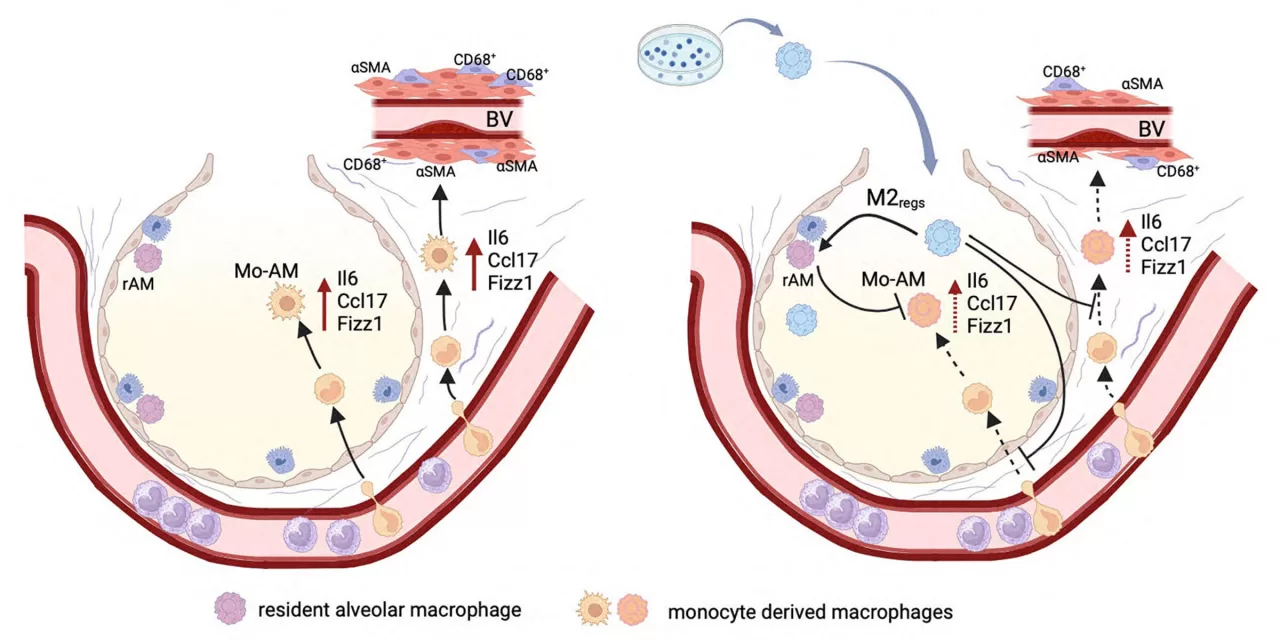 New Research Suggests Macrophage Modification Could Prevent Pulmonary Hypertension