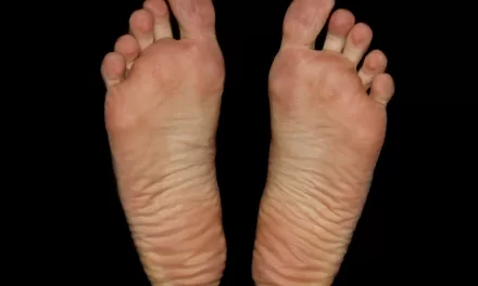 Why You Should Check for ‘Irish Pinky Toe’—And How to Care for It