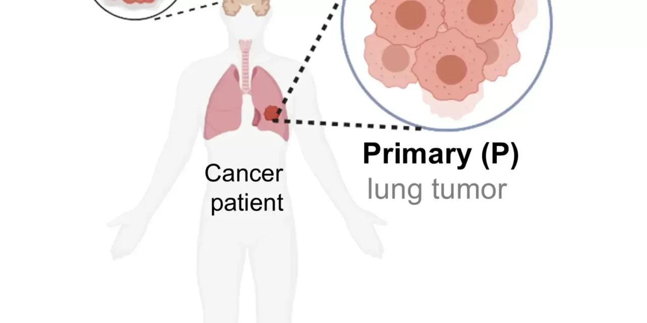 Natural Defense Mechanism May Help Slow Down Tumor Cell Metastasis