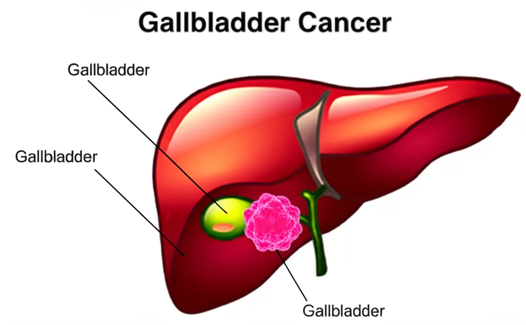 Gallbladder Cancer Risk Rises with Undetected Gallstones, PGI Study Finds