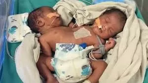 Rare Case of Parapagus Dicephalus Conjoined Twins Reported in Indore; Survival Chances Below 0.1%