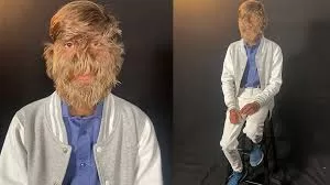 Werewolf Syndrome: 18-Year-Old Indian Boy Breaks Guinness World Record for Hairiest Face, Highlights Rare Hypertrichosis Condition