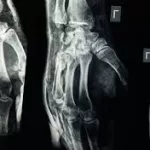 India’s Silent Fracture: Why Osteoporosis Is Striking Indians Under 50