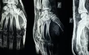 Chinese Scientists Unveil Revolutionary Bone Glue That Repairs Fractures in Just Three Minutes