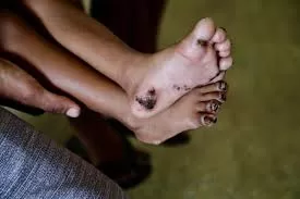 PAHO publishes first guidelines for the treatment of tungiasis, a neglected disease that affects millions