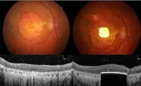 Retinal Implant Restores Central Vision in Patients with Age-Related Macular Degeneration